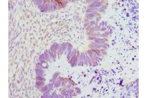 Immunohistochemistry of paraffin-embedded human ovarian cancer using ABIN7151362 at dilution of 1:100