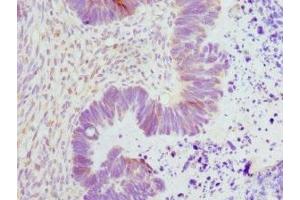 Immunohistochemistry of paraffin-embedded human ovarian cancer using ABIN7151362 at dilution of 1:100 (ENOX2 anticorps  (AA 411-610))
