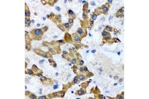 Immunohistochemical analysis of HAO1 staining in human liver cancer formalin fixed paraffin embedded tissue section.