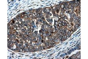 Immunohistochemical staining of paraffin-embedded Adenocarcinoma of colon tissue using anti-IFT57mouse monoclonal antibody. (IFT57 anticorps)