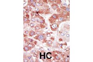 Formalin-fixed and paraffin-embedded human hepatocellular carcinoma tissue reacted with GRK7 polyclonal antibody  , which was peroxidase-conjugated to the secondary antibody, followed by AEC staining. (GRK7 anticorps  (C-Term))