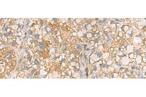 Immunohistochemistry of paraffin-embedded Human liver cancer tissue using ANXA13 Polyclonal Antibody at dilution of 1:105(x200)