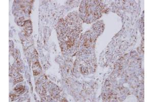 IHC-P Image Immunohistochemical analysis of paraffin-embedded human colon carcinoma, using NDUFS2, antibody at 1:250 dilution. (NDUFS2 anticorps  (Center))