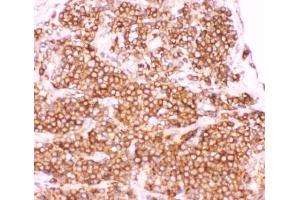 IHC-P: p50 antibody testing of human lung cancer tissue