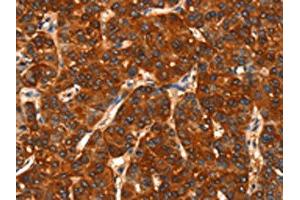 The image on the left is immunohistochemistry of paraffin-embedded Human liver cancer tissue using ABIN7190469(DHH Antibody) at dilution 1/25, on the right is treated with synthetic peptide. (desert Hedgehog anticorps)