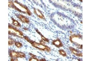 Formalin-fixed, paraffin-embedded human gastric carcinoma stained with Mucin-6 antibody (MUC6/916). (MUC6 anticorps)