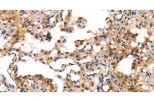 Immunohistochemistry of paraffin-embedded Human thyroid cancer tissue using CUL4B Polyclonal Antibody at dilution 1:50