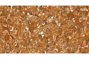 Immunohistochemistry of paraffin-embedded Human liver cancer using PYGM Polyclonal Antibody at dilution of 1:30