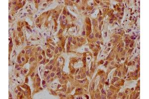 IHC image of ABIN7146186 diluted at 1:300 and staining in paraffin-embedded human liver cancer performed on a Leica BondTM system.