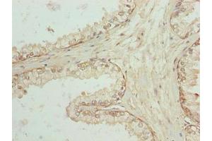 Immunohistochemistry of paraffin-embedded human prostate cancer using ABIN7168900 at dilution of 1:100