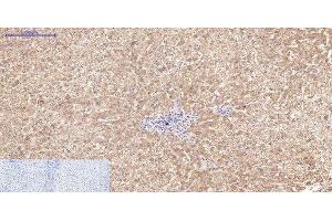 Immunohistochemistry of paraffin-embedded Human liver tissue using Active CASP3 Monoclonal Antibody at dilution of 1:200. (Active CASP3 anticorps)