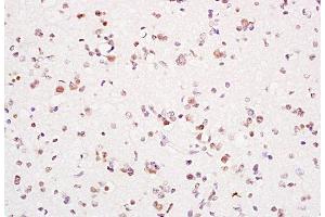Formalin-fixed and paraffin embedded human glioma tissue labeled with Anti-PCNA Polyclonal Antibody, Unconjugated  at 1:200 followed by conjugation to the secondary antibody and DAB staining (PCNA anticorps  (AA 151-261))