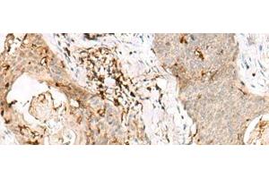 Immunohistochemistry of paraffin-embedded Human esophagus cancer tissue using OVOL2 Polyclonal Antibody at dilution of 1:50(x200) (OVOL2 anticorps)