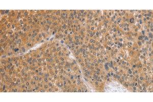 Immunohistochemistry of paraffin-embedded Human liver cancer using BRS3 Polyclonal Antibody at dilution of 1:50 (BRS3 anticorps)