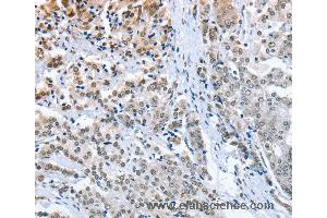 Immunohistochemistry of Human prostate cancer using ELAVL1 Polyclonal Antibody at dilution of 1:50 (ELAVL1 anticorps)