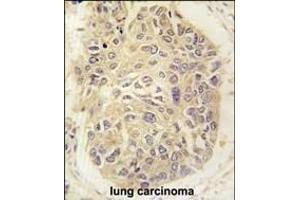 Formalin-fixed and paraffin-embedded human lung carcinoma tissue reacted with FARSA antibody (N-term) (ABIN391817 and ABIN2841665) , which was peroxidase-conjugated to the secondary antibody, followed by DAB staining. (Phenylalanyl-tRNA Synthetase, alpha Subunit (FARSA) (AA 54-83), (N-Term) anticorps)