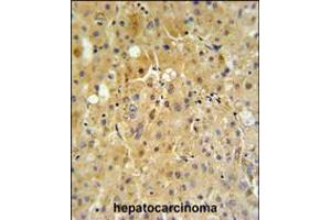 P450R Antibody IHC analysis in formalin fixed and paraffin embedded human hepatocarcinoma tissue followed by peroxidase conjugation of the secondary antibody and DAB staining. (CYP2B6 anticorps  (AA 462-488))