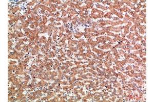 Immunohistochemical analysis of paraffin-embedded human-liver-cancer, antibody was diluted at 1:200
