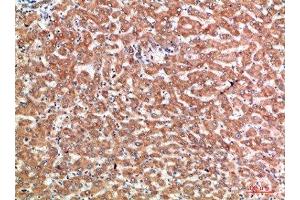 Immunohistochemical analysis of paraffin-embedded human-liver-cancer, antibody was diluted at 1:200 (CD137 anticorps  (AA 111-160))