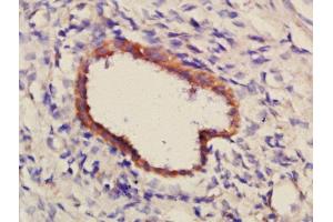 Formalin-fixed and paraffin embedded human glioma tissue labeled with Anti-PCDH7 Polyclonal Antibody, Unconjugated (ABIN1386405) at 1:300 followed by conjugation to the secondary antibody and DAB staining. (PCDH7 anticorps  (AA 431-530))