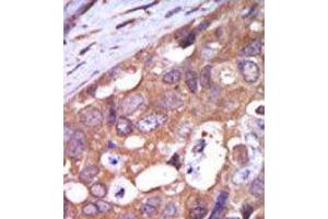 Formalin-fixed and paraffin-embedded human cancer tissue reacted with the primary antibody, which was peroxidase-conjugated to the secondary antibody, followed by AEC staining. (PKC mu anticorps  (N-Term))