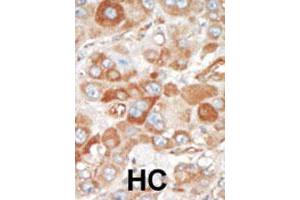 Formalin-fixed and paraffin-embedded human hepatocellular carcinoma tissue reacted with SRPK2 polyclonal antibody  , which was peroxidase-conjugated to the secondary antibody, followed by DAB staining. (SRPK2 anticorps  (C-Term))