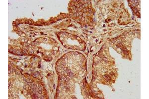 IHC image of ABIN7175101 diluted at 1:200 and staining in paraffin-embedded human prostate cancer performed on a Leica BondTM system.