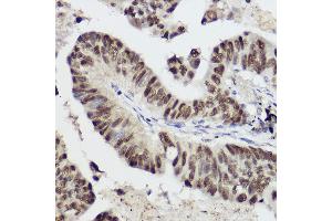 Immunohistochemistry of paraffin-embedded human lung cancer using ST Rabbit pAb (ABIN3020614, ABIN3020615, ABIN3020616 and ABIN6213588) at dilution of 1:50 (40x lens). (STAT1 anticorps  (AA 513-712))