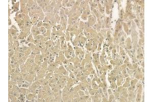 at 1/100 staining human hepatocellular carcinoma by IHC-P. (HCLS1 anticorps  (Internal Region))
