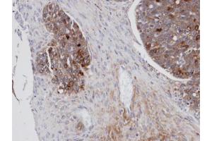 IHC-P Image Immunohistochemical analysis of paraffin-embedded human serous ovarian cancer, using MSLN, antibody at 1:100 dilution. (Mesothelin anticorps)