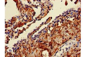 Immunohistochemistry of paraffin-embedded human lung cancer using ABIN7152377 at dilution of 1:100 (CAPZA2 anticorps  (AA 2-286))