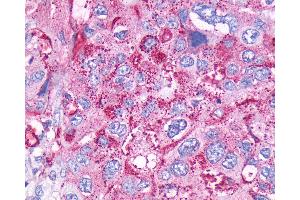 Anti-CCKBR / Cckb antibody IHC of human Pancreas, Carcinoma. (CCKBR anticorps  (Cytoplasmic Domain))