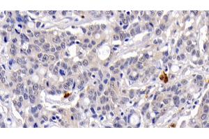 Detection of CASP3 in Human Lymphoma Tissue using Monoclonal Antibody to Caspase 3 (CASP3)