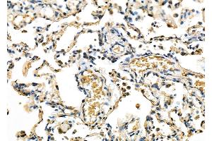 ABIN6263447 and ABIN6278081 at 1/100 staining Human lung cancer and adjacent non-tumor tissue by IHC-P. (MXD3 anticorps  (Internal Region))