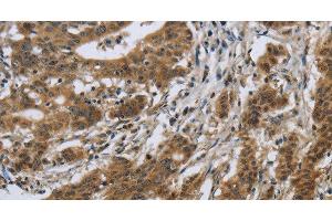 Immunohistochemistry of paraffin-embedded Human gastric cancer using IL5RA Polyclonal Antibody at dilution of 1:40 (IL5RA anticorps)
