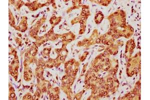 IHC image of ABIN7162837 diluted at 1:400 and staining in paraffin-embedded human liver cancer performed on a Leica BondTM system.