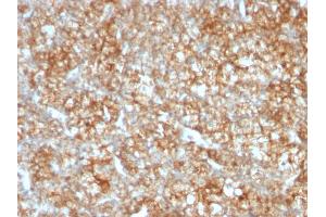 Formalin-fixed, paraffin-embedded human Renal Cell Carcinoma stained with CD147 Mouse Monoclonal Antibody (BSG/963).