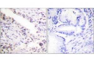 Immunohistochemistry analysis of paraffin-embedded human prostate carcinoma tissue, using Smad2 (Ab-467) Antibody.