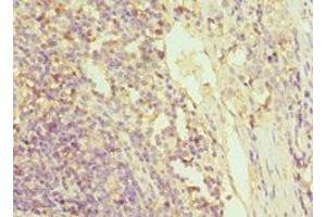 Immunohistochemistry of paraffin-embedded human colon cancer using ABIN7154393 at dilution of 1:100 (Granulin anticorps  (AA 20-310))
