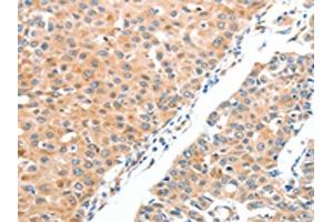 The image on the left is immunohistochemistry of paraffin-embedded Human breast cancer tissue using ABIN7128229(ADAM2 Antibody) at dilution 1/20, on the right is treated with fusion protein. (ADAM2 anticorps)
