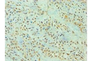 Immunohistochemistry of paraffin-embedded human breast cancer using ABIN7166926 at dilution of 1:100 (TP53I3 anticorps  (AA 163-332))