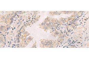 Immunohistochemistry of paraffin-embedded Human prost at e cancer tissue using TNNT1 Polyclonal Antibody at dilution of 1:35(x200)