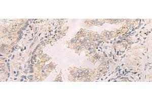 Immunohistochemistry of paraffin-embedded Human prost at e cancer tissue using TNNT1 Polyclonal Antibody at dilution of 1:35(x200) (TNNT1 anticorps)