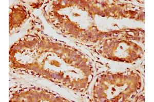 IHC image of ABIN7170953 diluted at 1:1000 and staining in paraffin-embedded human breast cancer performed on a Leica BondTM system.