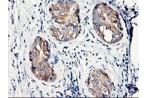 Immunohistochemical staining of paraffin-embedded Adenocarcinoma of Human breast tissue using anti-EIF2B3 mouse monoclonal antibody. (EIF2B3 anticorps)