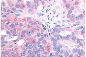 Human Ovarian Carcinoma (formalin-fixed, paraffin-embedded) stained with EGFR antibody ABIN213615 at 2. (EGFR anticorps  (C-Term))