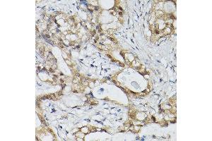 Immunohistochemistry of paraffin-embedded human lung cancer using ESE1/ELF3 Rabbit pAb (ABIN6130347, ABIN6140125, ABIN6140127 and ABIN6221990) at dilution of 1:150 (40x lens). (ELF3 anticorps  (AA 1-280))