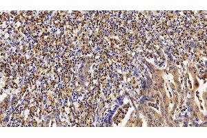 Detection of IL4R in Human Stomach cancer Tissue using Polyclonal Antibody to Interleukin 4 Receptor (IL4R) (IL4 Receptor anticorps  (AA 26-232))