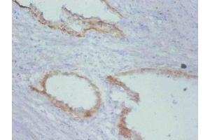 Immunohistochemistry of paraffin-embedded human prostate cancer using ABIN7172200 at dilution of 1:100 (TIMP1 anticorps)