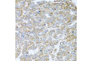 Immunohistochemistry of paraffin-embedded human liver cancer using NDUFA2 antibody at dilution of 1:100 (x40 lens). (NDUFA2 anticorps)